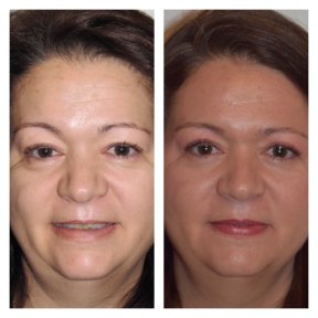 Before and after facial fat transfer at Clinica Granado Tiagonce, rejuvenation results