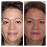 Before and after facial fat transfer at Clinica Granado Tiagonce, rejuvenation results