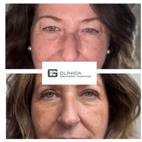 Before and after facial fat transfer results at Clinica Granado Tiagonce, facial rejuvenation