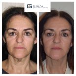 Before and after facial fat transfer at Clinica Granado Tiagonce, rejuvenation results shown