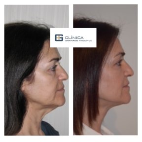 Before and after facial fat transfer at Clinica Granado Tiagonce, rejuvenation result