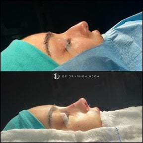 Vorher-nachher-Ergebnis der Nasenkorrektur in Liv Hospital Vadistanbul, verbesserte Nasenform