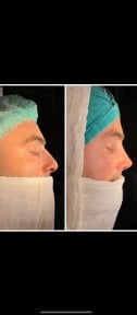 Vorher-nachher-Ergebnis der Nasenkorrektur in Liv Hospital Vadistanbul, verbesserte Nasenform
