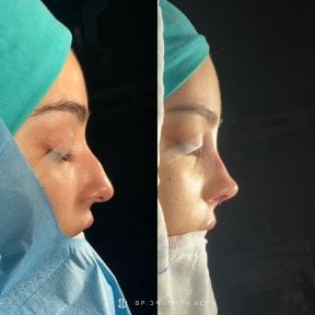 Vorher-nachher-Ergebnisse der Nasenkorrektur in Liv Hospital Vadistanbul, Rhinoplastik