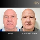 Before and after upper and lower eyelid surgery results at ID Clinic Bangkok, 1 month post-op