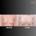 Результаты до и после увеличения груди в ID Clinic Bangkok, увеличенный объем груди