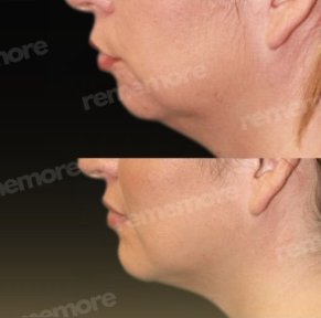 Vorher-nachher-Ergebnis Kinnimplantat bei Memorial Bahçelievler Hospital, verbesserte Kontur