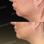 Vorher-nachher-Ergebnis Kinnimplantat bei Memorial Bahçelievler Hospital, verbesserte Kontur
