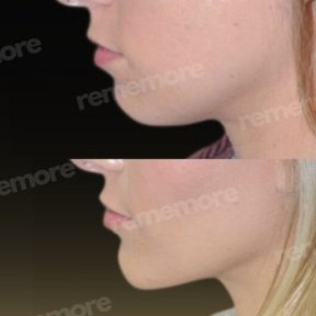 Vorher-nachher-Ergebnis Kinnimplantat bei Memorial Bahçelievler Hospital, verbessertes Profil