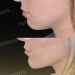 Vorher-nachher-Ergebnis Kinnimplantat bei Memorial Bahçelievler Hospital, verbessertes Profil