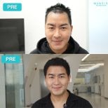 PRP hair loss treatment results at Wansiri Hospital – improved hair density and hairline