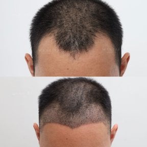 Before and after PRP hair loss treatment results at Wansiri Hospital, improved hair density