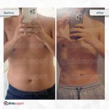 360 liposuction before and after results at CE International Hospital, improved body contour