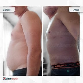 360 liposuction before and after results at CE International Hospital, improved body contour
