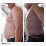 360 liposuction before and after results at CE International Hospital, improved body contour