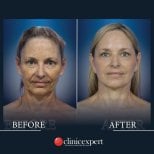 Résultats avant et après lifting du cou à CE International Hospital, rajeunissement visible