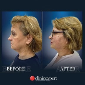 Résultats lifting du cou avant/après à CE International Hospital, amélioration de la mâchoire