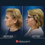 Résultats lifting du cou avant/après à CE International Hospital, amélioration de la mâchoire