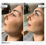 Before and after neck lift results at CE International Hospital, visible jawline and neck contour