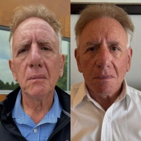 Before and after neck lift results at CE International Hospital, visible neck tightening effect