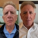 Before and after neck lift results at CE International Hospital, visible neck tightening effect