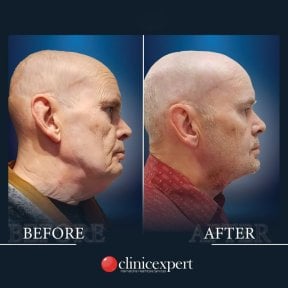 Before and after neck lift results at CE International Hospital, visible neck contour improvement