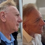 Before and after neck lift results at CE International Hospital, visible neck tightening effect