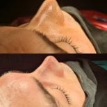 Efekty przed i po septoplastyce w ÜMRAN TIP MERKEZİ, poprawiony profil nosa