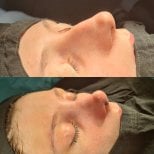 Efekty przed i po septoplastyce w ÜMRAN TIP MERKEZİ, poprawa oddychania przez nos