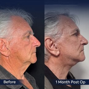 Before and after neck lift results at Dr. Safa Manav Clinic, visible jawline improvement