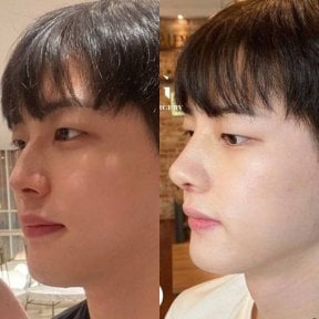 Результаты ринопластики до и после в VG Plastic Surgery, улучшенная форма носа и профиль