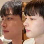 Результаты ринопластики до и после в VG Plastic Surgery, улучшенная форма носа и профиль