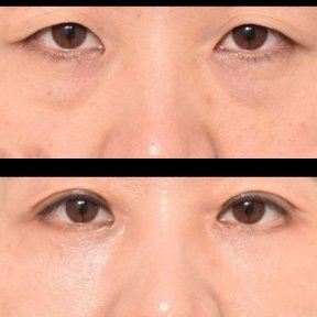 Before and after lower eyelid blepharoplasty results at VG Plastic Surgery, reduced eye bags