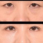 Before and after lower eyelid blepharoplasty results at VG Plastic Surgery, reduced eye bags