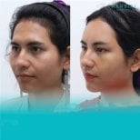 Facelift before and after results at Wansiri Hospital – visible facial rejuvenation outcome