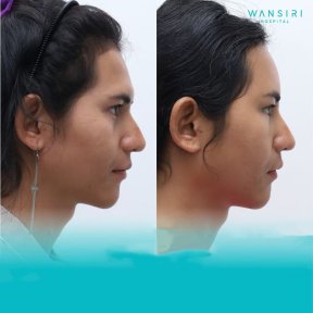 Facelift before and after results at Wansiri Hospital, visible facial contour improvement