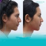 Facelift before and after results at Wansiri Hospital, visible facial contour improvement