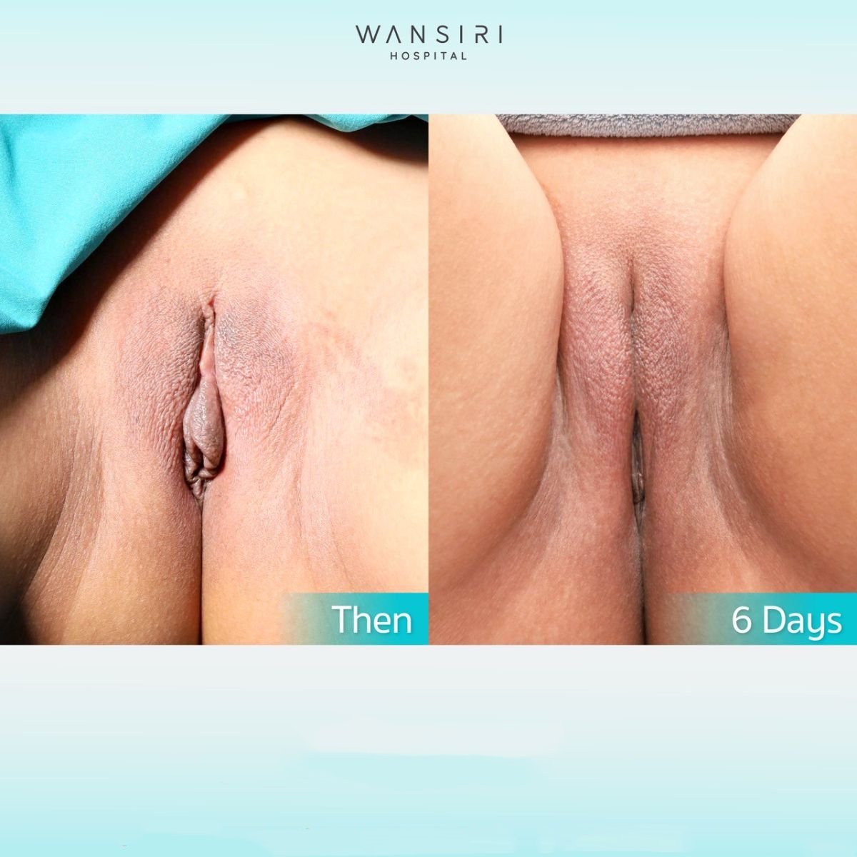 Resultados de antes y después de labioplastia en Wansiri Hospital – mejora visible tras 6 días