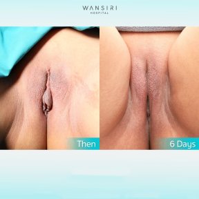 Результати до і після лабіопластики у Wansiri Hospital – покращення через 6 днів