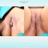 Результати до і після лабіопластики у Wansiri Hospital – покращення через 6 днів