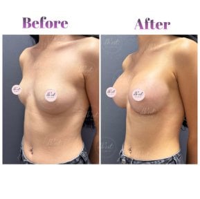 Vorher-nachher-Ergebnis der Mammoplastik bei Db'est Clinic – verbesserte Brustform und Volumen
