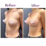 Vorher-nachher-Ergebnis der Mammoplastik bei Db'est Clinic – verbesserte Brustform und Volumen