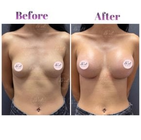 Vorher-nachher-Ergebnisse der Mammoplastik bei Db'est Clinic – verbesserte Brustform