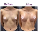 Vorher-nachher-Ergebnisse der Mammoplastik bei Db'est Clinic – verbesserte Brustform