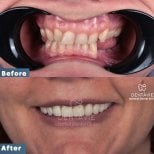 Before and after dental implant results at Dentavie Istanbul Dental Clinic, improved smile