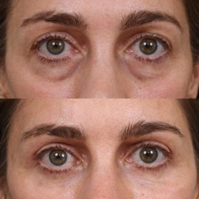 Blepharoplastik Vorher-Nachher-Ergebnis bei Medical Park Antalya Hospital Complex, Lidkorrektur