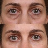 Blepharoplastik Vorher-Nachher-Ergebnis bei Medical Park Antalya Hospital Complex, Lidkorrektur
