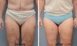 Before and after Morpheus8 skin tightening results on thighs at ID Clinic Bangkok