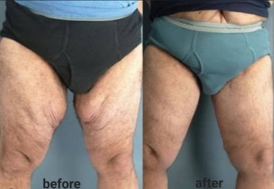 Before and after Morpheus8 skin tightening results on thighs at ID Clinic Bangkok