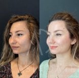 Vorher-nachher-Ergebnis der Nasenkorrektur in Liv Hospital Ulus, natürliche Nasenform